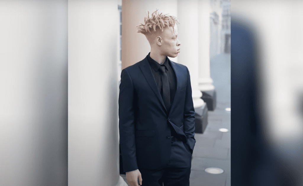 The Unique Journey of an African American Albino