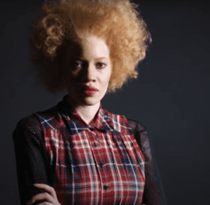 Albino African American Models